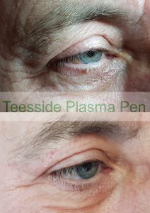 Plasma Pen to Upper Eyelids and Crows Feet
