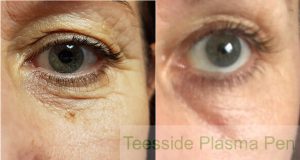 Before and 3 weeks after a single plasma pen treatment to the lower lids