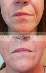 Plasma Pen before and after, lines around the mouth and jowls