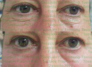 Lower eyelids before and two weeks after a single plasma pen treatment