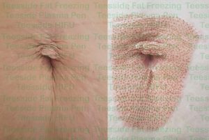 Navel Tummy Button Plasma Pen Before and After Photo